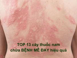 TOP 13 cây thuốc nam chữa bệnh mề đay hiệu quả, dễ tìm ở Việt Nam