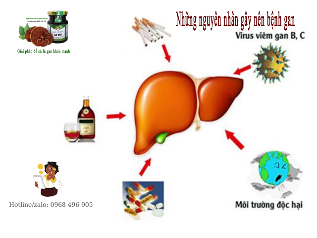 Rượu, các chất bảo quản, ô nhiễm là một trong những nguyên nhân gây ra bệnh gan