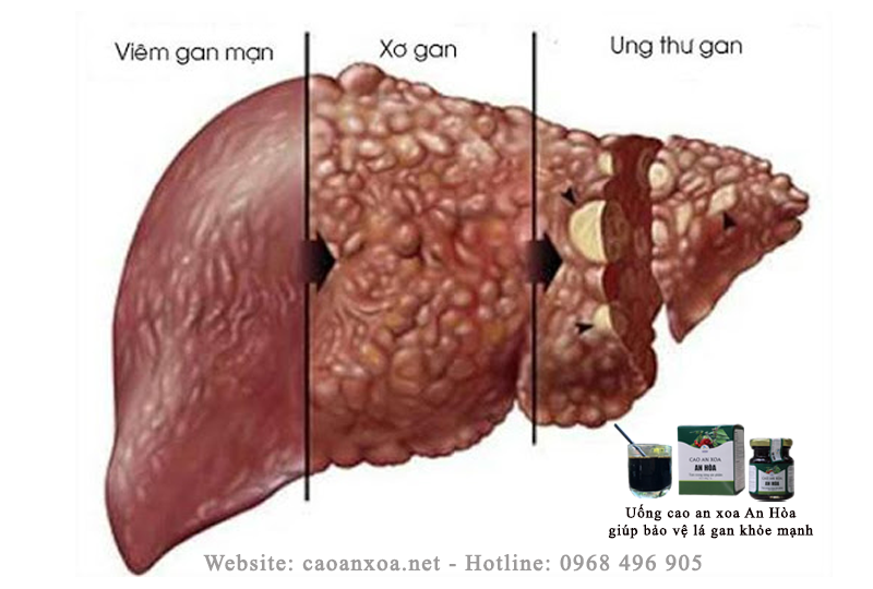 Nhiễm virus viêm gan B, C mãn tính: gây nên viêm gan, xơ gan và phát triển thành ung thư gan.