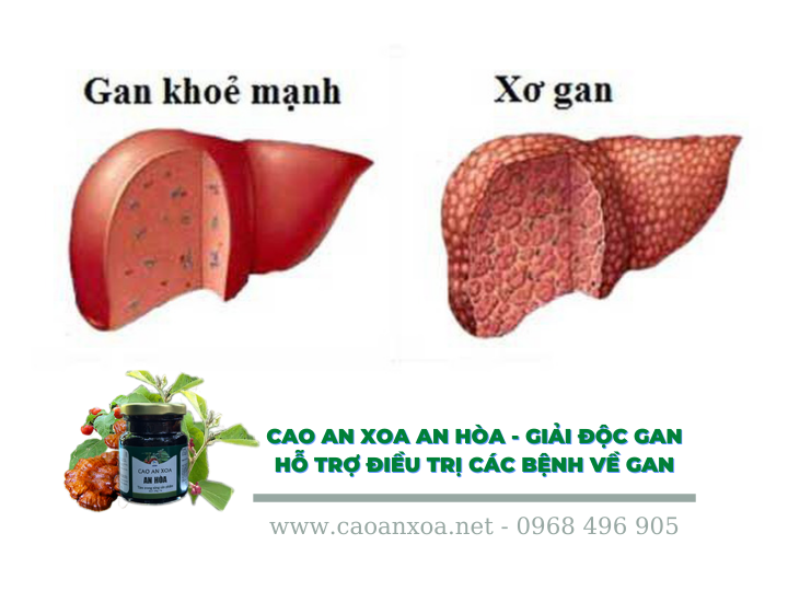 Xơ gan làm cho các chức năng quan trọng của gan bị suy giảm